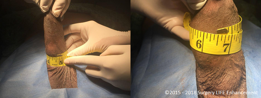 Before and after Surgery Life Enhancement PMMA girth enhancement injection.