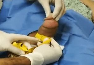 Non-Surgical Penis Enlargement Procedures.