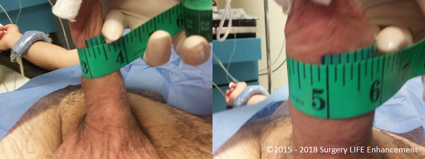Patient's penis gains 2 inches before and after image of a SLE 60cc PMMA Max girth enhancement.