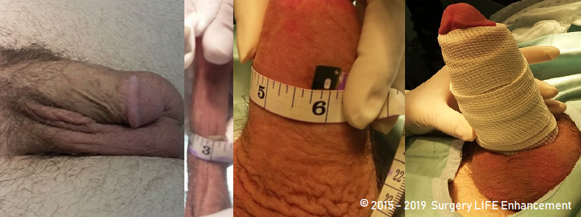 Before and after 60cc PMMA penis enlargement injections by Surgery LIFE Enhancement.
