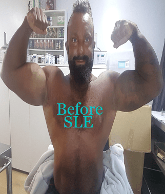 Before SLE Muscle Site Enhancement with PMMA Injections.