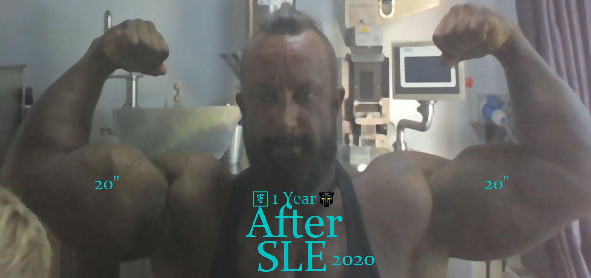 Surgery LIFE Enhancement patient's PMMA muscle site enhancement results 1 year after his non-surgical procedure. title=